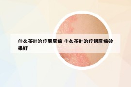 什么茶葉治療銀屑病 什么茶葉治療銀屑病效果好