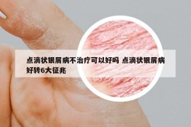 點滴狀銀屑病不治療可以好嗎 點滴狀銀屑病好轉(zhuǎn)6大征兆