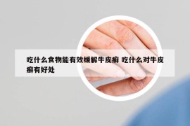 吃什么食物能有效緩解牛皮癬 吃什么對(duì)牛皮癬有好處