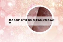 臉上長紅的是牛皮癬嗎 臉上長紅皮癬怎么治療
