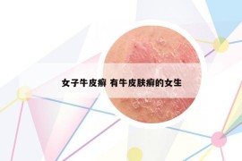 女子牛皮癬 有牛皮膚癬的女生