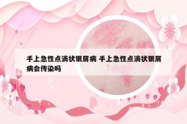 手上急性點滴狀銀屑病 手上急性點滴狀銀屑病會傳染嗎