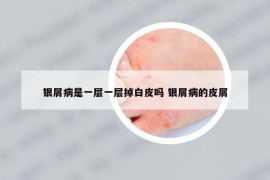 銀屑病是一層一層掉白皮嗎 銀屑病的皮屑