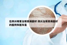 在四川哪里治銀屑病最好 四川治銀屑病最好的醫(yī)院和醫(yī)生是
