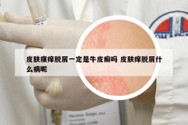 皮膚瘙癢脫屑一定是牛皮癬嗎 皮膚癢脫屑什么病呢