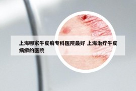 上海哪家牛皮癬?？漆t(yī)院最好 上海治療牛皮病癬的醫(yī)院