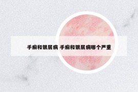手癬和銀屑病 手癬和銀屑病哪個嚴重