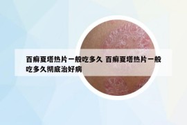百癬夏塔熱片一般吃多久 百癬夏塔熱片一般吃多久徹底治好病
