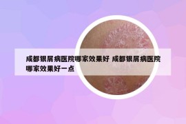 成都銀屑病醫(yī)院哪家效果好 成都銀屑病醫(yī)院哪家效果好一點(diǎn)
