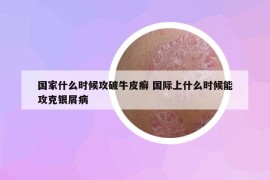國家什么時候攻破牛皮癬 國際上什么時候能攻克銀屑病