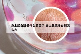 身上起白斑是什么原因了 身上起很多白斑怎么辦