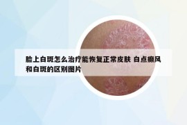 臉上白斑怎么治療能恢復(fù)正常皮膚 白點(diǎn)癲風(fēng)和白斑的區(qū)別圖片