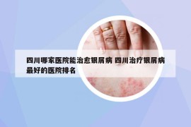 四川哪家醫(yī)院能治愈銀屑病 四川治療銀屑病最好的醫(yī)院排名