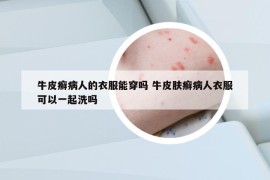 牛皮癬病人的衣服能穿嗎 牛皮膚癬病人衣服可以一起洗嗎