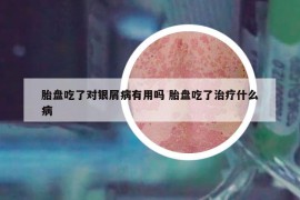 胎盤吃了對(duì)銀屑病有用嗎 胎盤吃了治療什么病