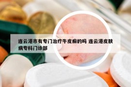 連云港市有專門治療牛皮癬的嗎 連云港皮膚病專科門診部