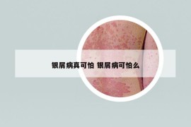 銀屑病真可怕 銀屑病可怕么