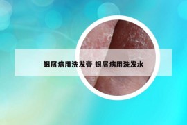 銀屑病用洗發(fā)膏 銀屑病用洗發(fā)水