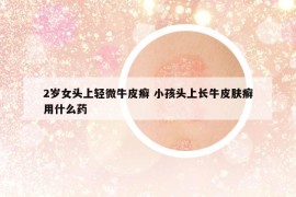 2歲女頭上輕微牛皮癬 小孩頭上長牛皮膚癬用什么藥