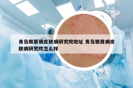 青島銀屑病皮膚病研究院地址 青島銀屑病皮膚病研究院怎么樣