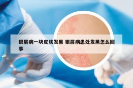 銀屑病一塊皮膚發(fā)黑 銀屑病患處發(fā)黑怎么回事