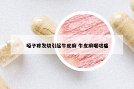 嗓子疼發(fā)燒引起牛皮癬 牛皮癬喉嚨痛