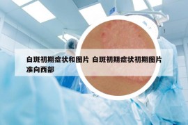 白斑初期癥狀和圖片 白斑初期癥狀初期圖片準(zhǔn)向西部