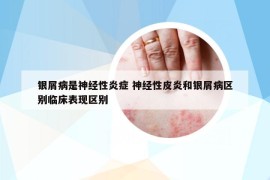 銀屑病是神經(jīng)性炎癥 神經(jīng)性皮炎和銀屑病區(qū)別臨床表現(xiàn)區(qū)別