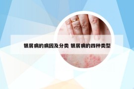 銀屑病的病因及分類 銀屑病的四種類型