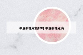牛皮癬掛水能好嗎 牛皮癬掛點(diǎn)滴