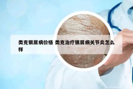 類克銀屑病價(jià)格 類克治療銀屑病關(guān)節(jié)炎怎么樣