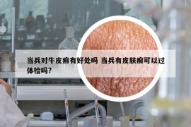 當(dāng)兵對(duì)牛皮癬有好處嗎 當(dāng)兵有皮膚癬可以過體檢嗎?
