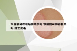 銀屑病可以引起肺結(jié)節(jié)嗎 銀屑病與肺部有關嗎,肺主皮毛