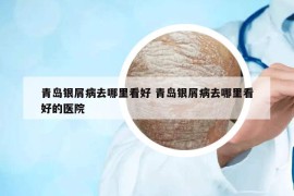 青島銀屑病去哪里看好 青島銀屑病去哪里看好的醫(yī)院