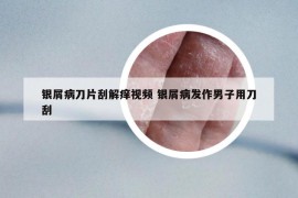 銀屑病刀片刮解癢視頻 銀屑病發(fā)作男子用刀刮