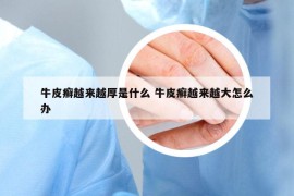 牛皮癬越來越厚是什么 牛皮癬越來越大怎么辦
