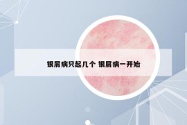 銀屑病只起幾個(gè) 銀屑病一開始