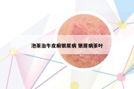泡茶治牛皮癬銀屑病 銀屑病茶葉