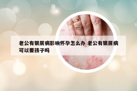 老公有銀屑病影響懷孕怎么辦 老公有銀屑病可以要孩子嗎