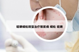硫磺蜈蚣斑蝥治療銀屑病 蜈蚣 硫磺