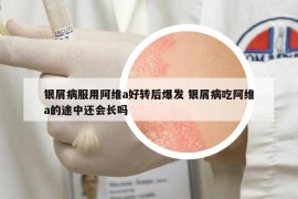 銀屑病服用阿維a好轉(zhuǎn)后爆發(fā) 銀屑病吃阿維a的途中還會長嗎