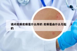 請問皮癬皮癬是什么樣的 皮癬是由什么引起的