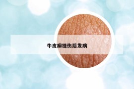 牛皮癬挫傷后發(fā)病