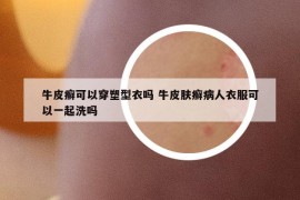 牛皮癬可以穿塑型衣嗎 牛皮膚癬病人衣服可以一起洗嗎