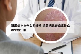 銀屑病補(bǔ)充什么多維嗎 銀屑病患者應(yīng)該補(bǔ)充哪些維生素