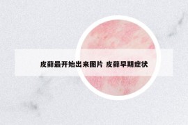 皮蘚最開始出來圖片 皮蘚早期癥狀