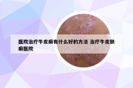 醫(yī)院治療牛皮癬有什么好的方法 治療牛皮膚癬醫(yī)院