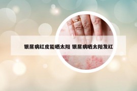 銀屑病紅皮能曬太陽 銀屑病曬太陽發(fā)紅