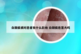 白顛瘋病對(duì)患者有什么影響 白顛瘋危害大嗎