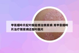 甲氨蝶呤片配葉酸能根治銀屑病 用甲氨蝶呤片治療銀屑病還服葉酸片